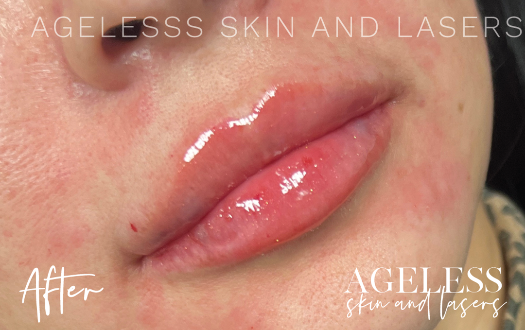 After Image: Lip Filler - right-front-oblique