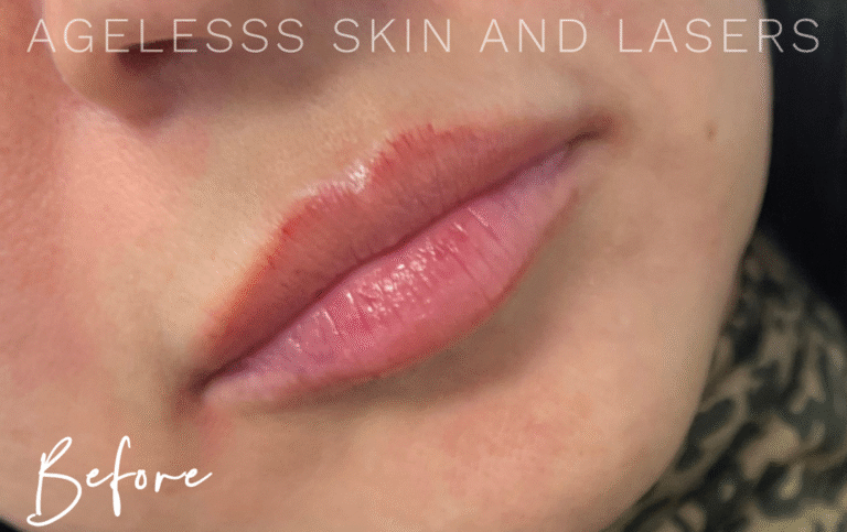 Before Image: Lip Filler - right-front-oblique