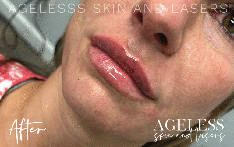 After Image: Lip Filler - left-front-oblique