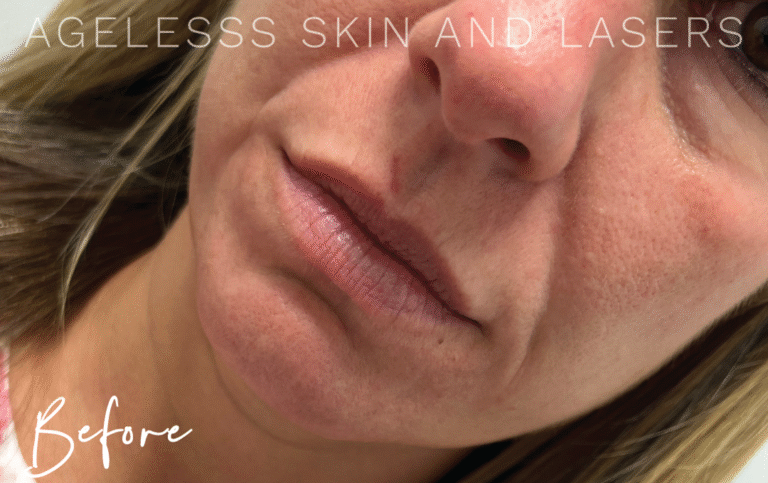 Before Image: Lip Filler - left-front-oblique