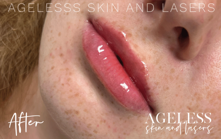 After Image: Lip Filler - left-front-oblique