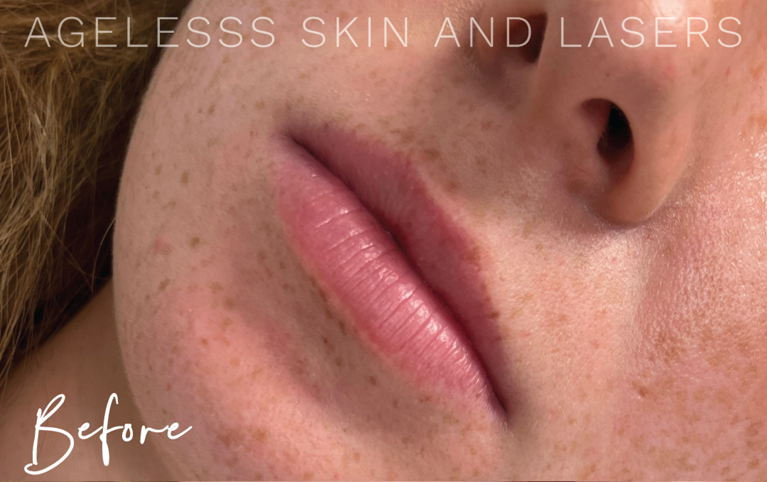 Before Image: Lip Filler - left-front-oblique