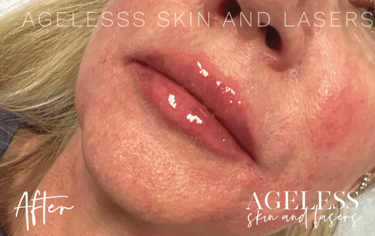 After Image: Lip Filler - left-front-oblique