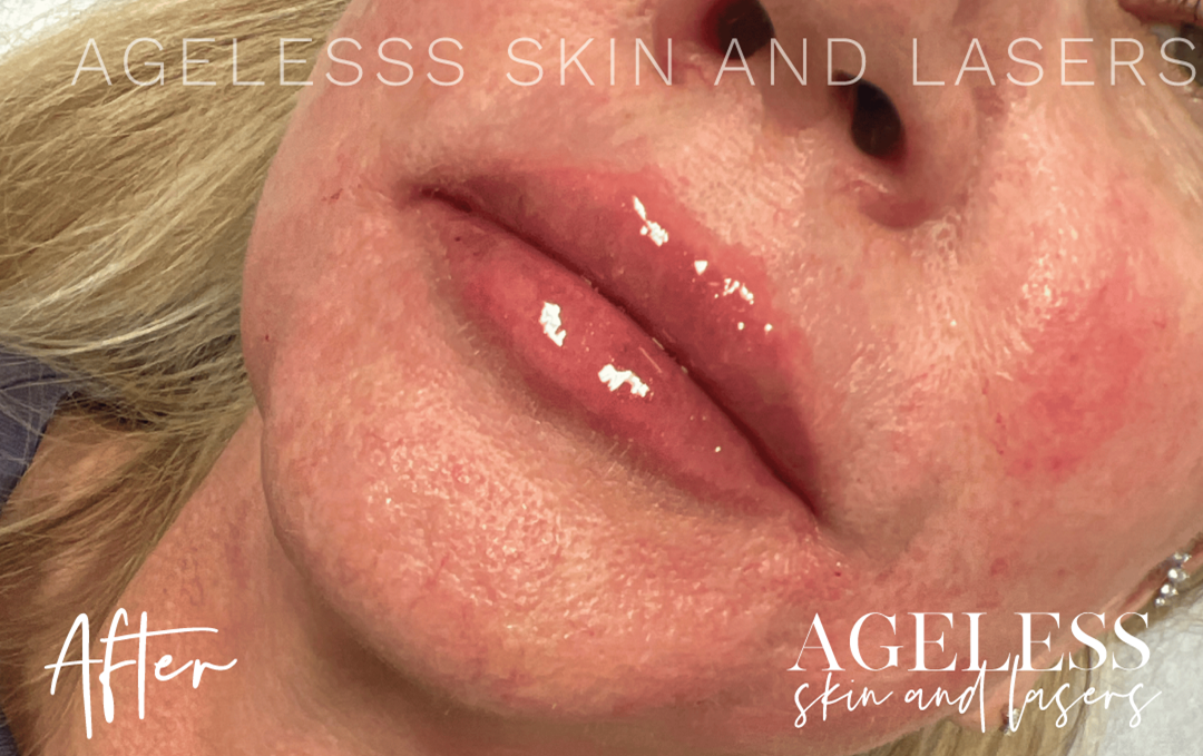 After Image: Lip Filler - left-front-oblique