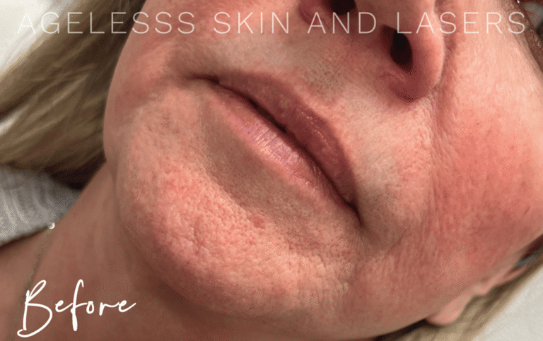 Before Image: Lip Filler - left-front-oblique