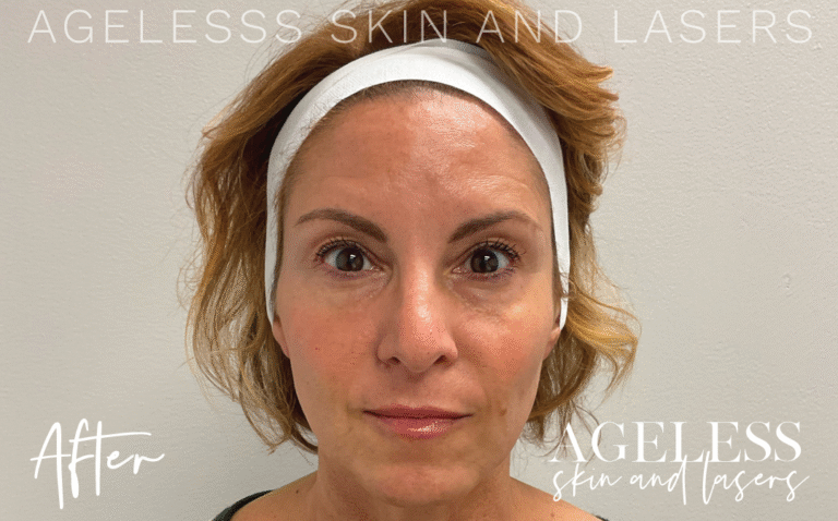 After Image: PRF EZ Gel Undereye and Facial Rejuvenation - front