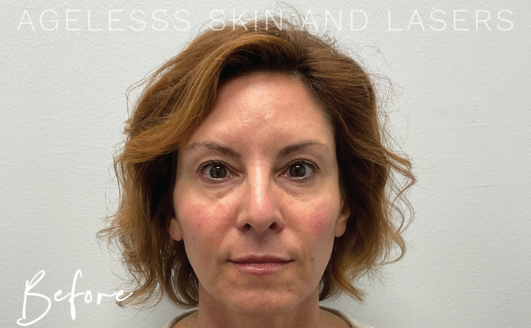 Before Image: PRF EZ Gel Undereye and Facial Rejuvenation - front