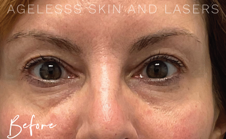 Before Image: PRF EZ Gel Undereye and Facial Rejuvenation - front