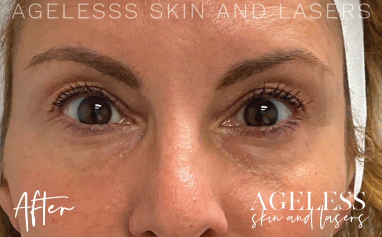 After Image: PRF EZ Gel Undereye and Facial Rejuvenation - front