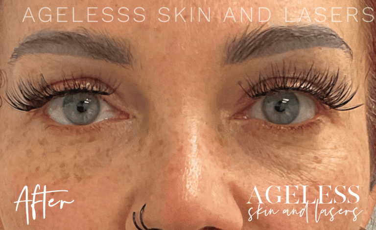 After Image: PRF EZ Gel Undereye and Facial Rejuvenation - front