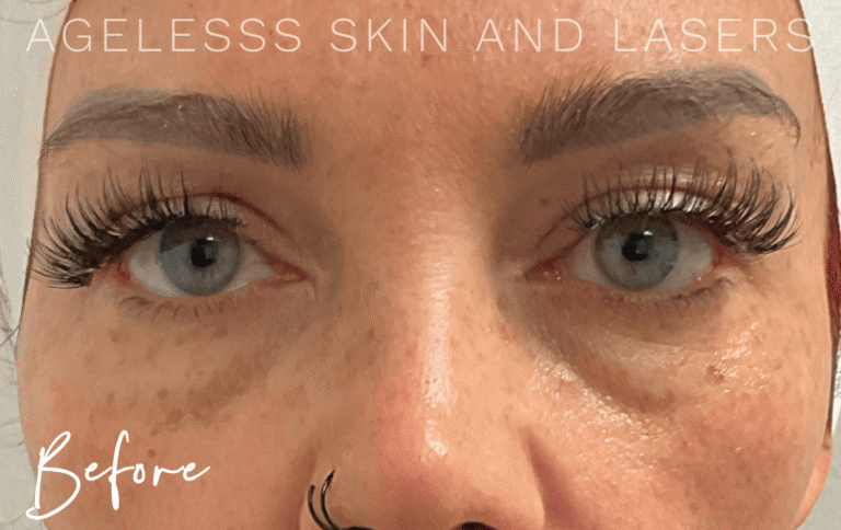 Before Image: PRF EZ Gel Undereye and Facial Rejuvenation - front