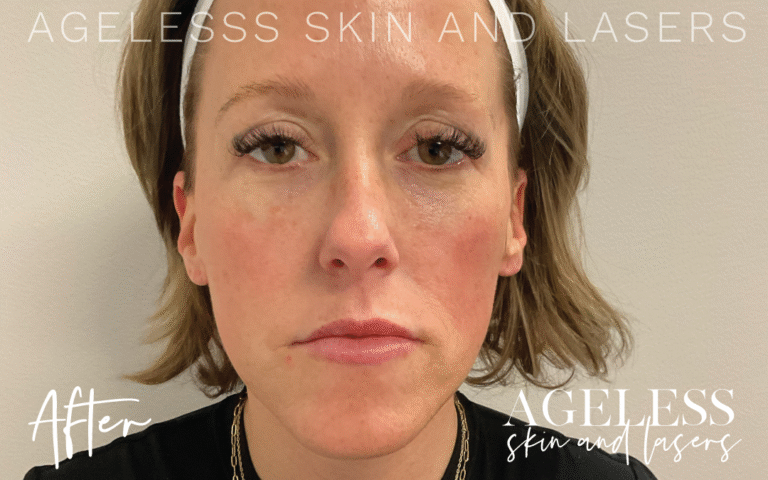 After Image: PRF EZ Gel Undereye and Facial Rejuvenation - front