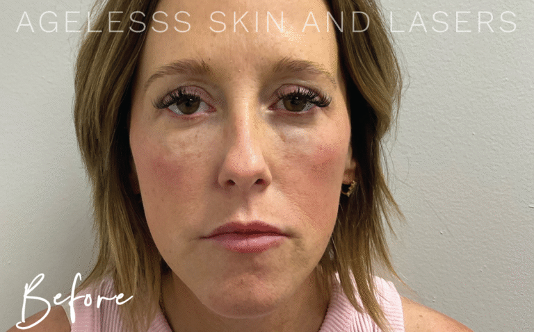 Before Image: PRF EZ Gel Undereye and Facial Rejuvenation - front