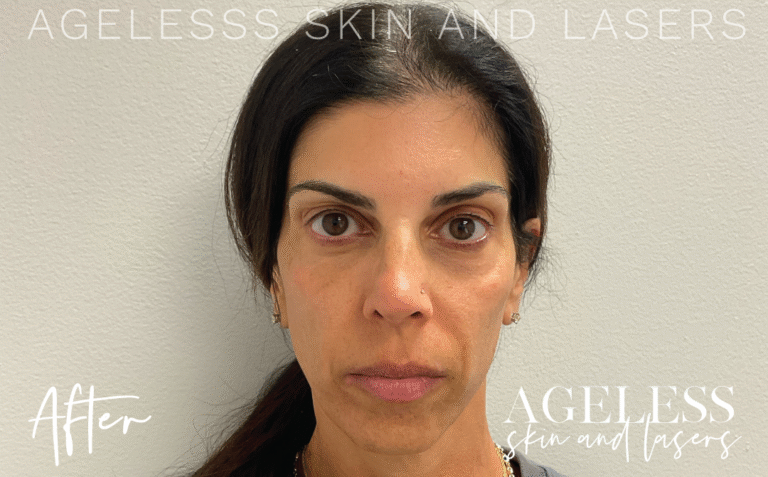 After Image: PRF EZ Gel Undereye and Facial Rejuvenation - front
