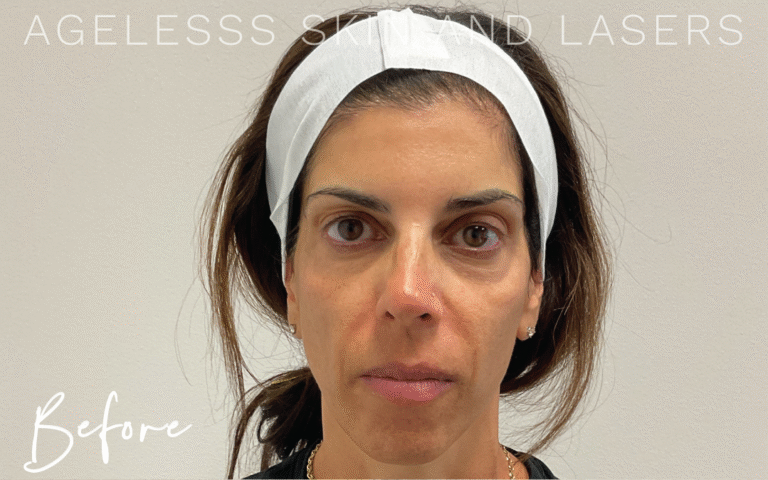 Before Image: PRF EZ Gel Undereye and Facial Rejuvenation - front