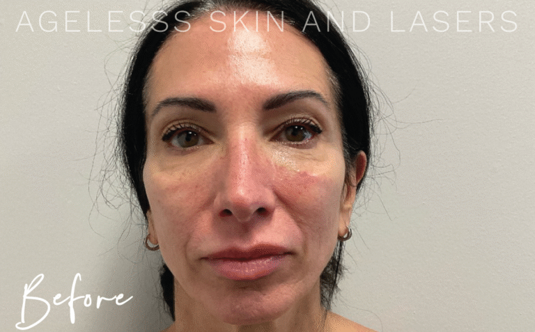 Before Image: Sculptra Bone Preserve - front