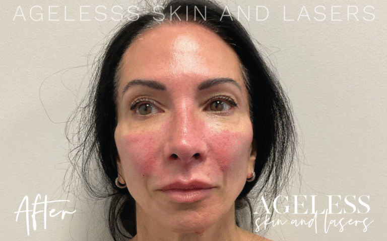 After Image: Sculptra Bone Preserve - front