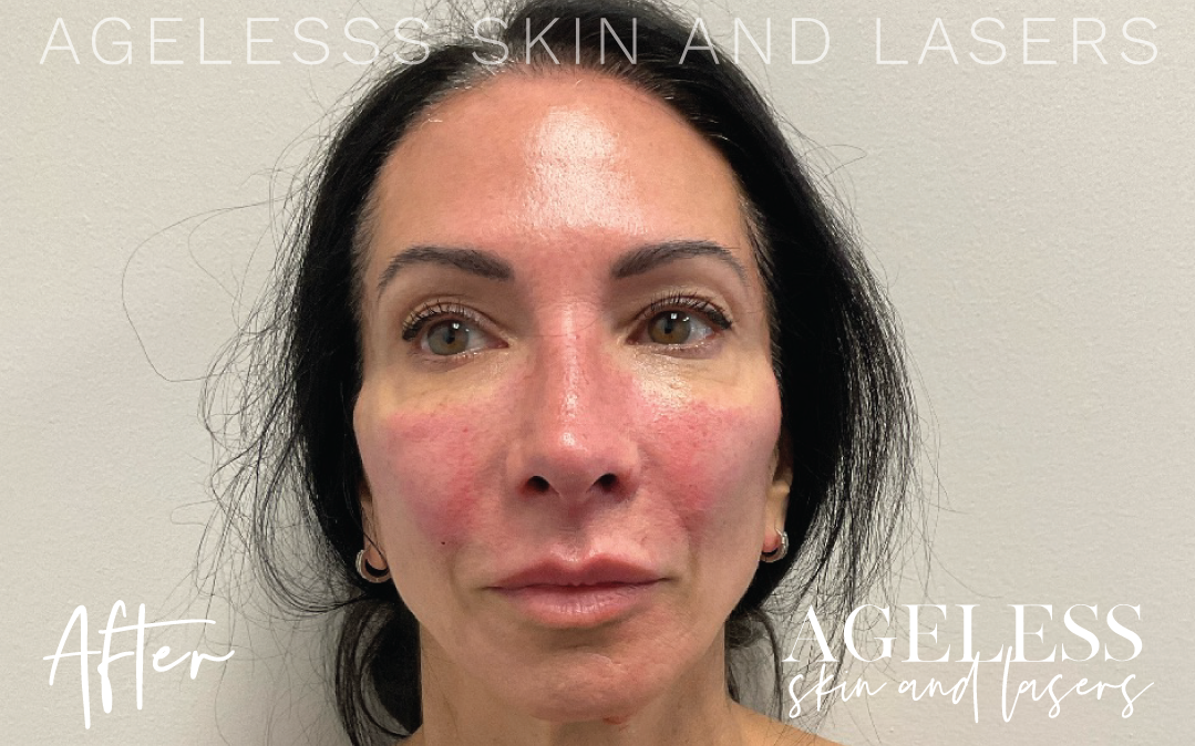 After Image: Sculptra Bone Preserve - front