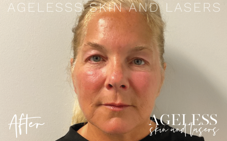 After Image: Hyperdilute Radiesse Skin Preserve - front