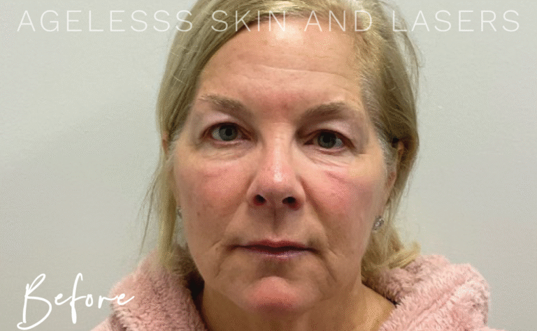 Before Image: Hyperdilute Radiesse Skin Preserve - front
