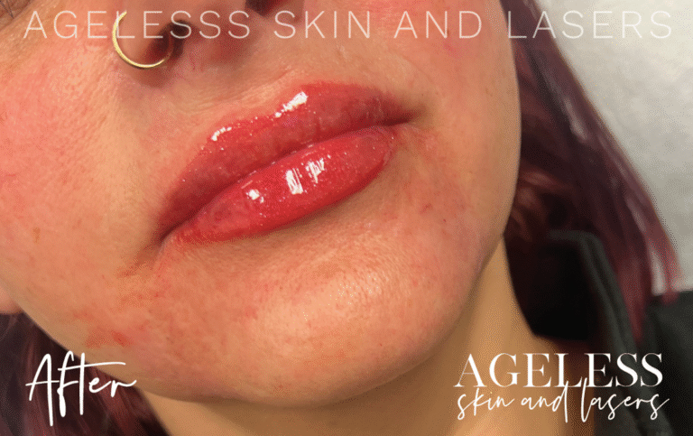 After Image: Lip Filler - right-front-oblique