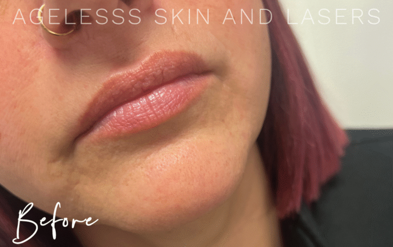 Before Image: Lip Filler - right-front-oblique