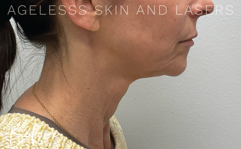 Before Image: Hyperdilute Neck Treatment - right-side