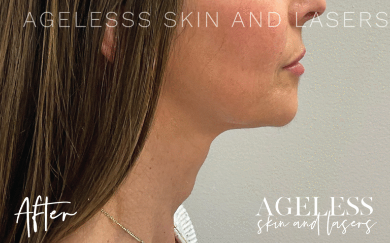 After Image: Hyperdilute Neck Treatment - right-side