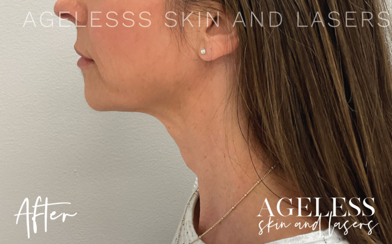 After Image: Hyperdilute Neck Treatment - left-side