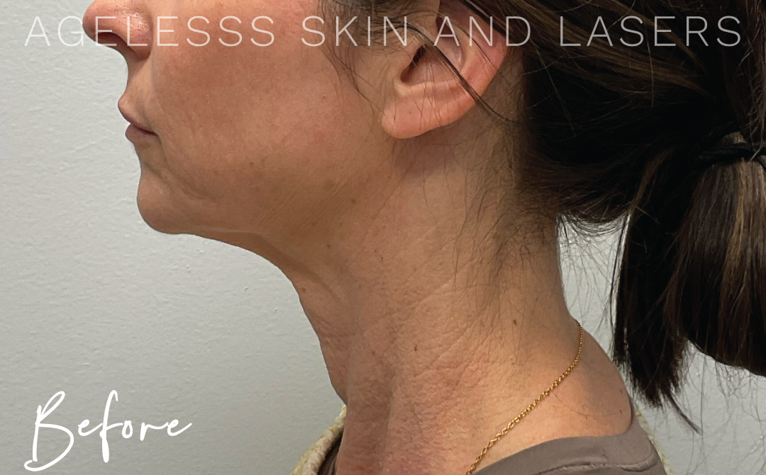 Before Image: Hyperdilute Neck Treatment - left-side