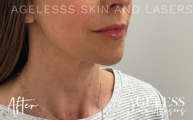 After Image: Hyperdilute Neck Treatment - right-front-oblique