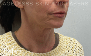 Before Image: Hyperdilute Neck Treatment