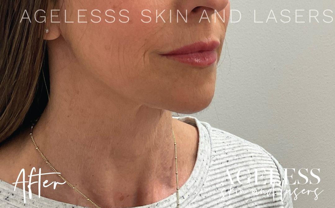 After Image: Hyperdilute Neck Treatment - right-front-oblique