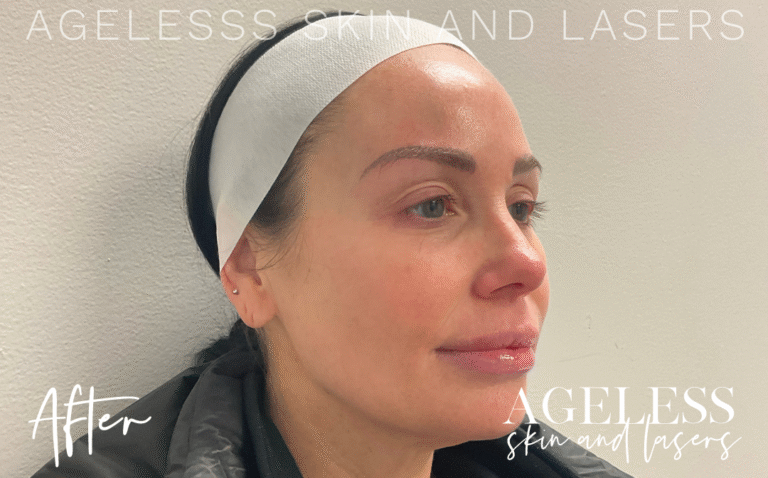 After Image: Radiesse 3 Point Lift - right-side