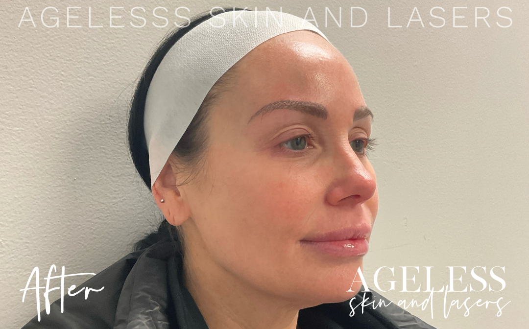 After Image: Radiesse 3 Point Lift - right-side