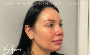 Before Image: Radiesse 3 Point Lift