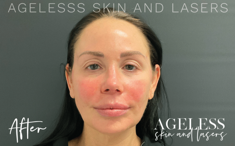 After Image: Radiesse 3 Point Lift - front