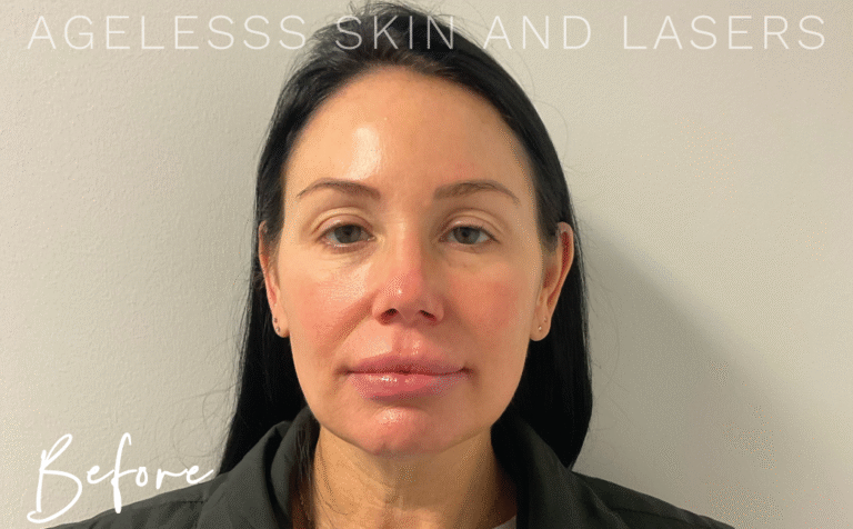 Before Image: Radiesse 3 Point Lift - front